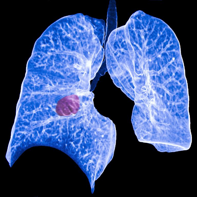karcinom pluća, primarni karcinom, primarni karcinom pluća, pluća može, raka pluća, sekundarni karcinom
