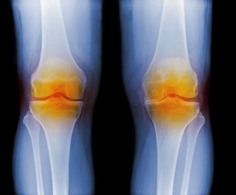 oštećenja zglobova, reumatoidnom artritisu, aktivnosti bolesti, progresivna oštećenja zglobova