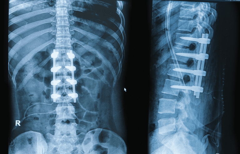 spinalne fuzije, nakon operacije, spinalna fuzija, AAOS kaže