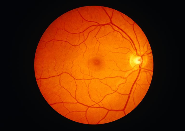 očne jabučice, retinalnog odvajanja, sloja ispod