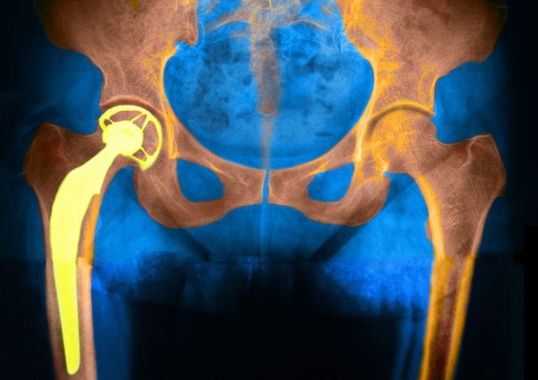 zamjene zglobova, zglobova često, često složeniji, dugo trajati, implantati mogu