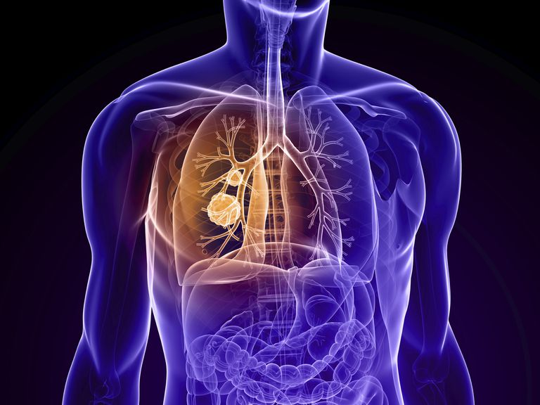raka pluća, karcinom pluća, ovoj fazi, pluća fazi, primarni karcinom