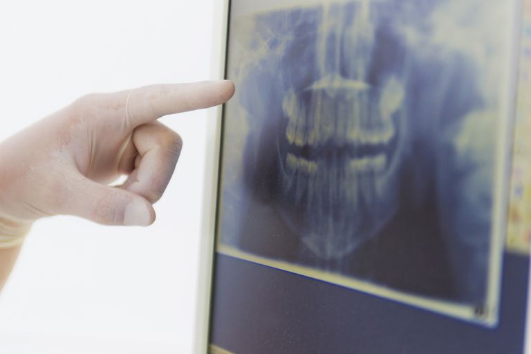 Supernumerary zubi, mogu uzrokovati, koji mogu, nadnaravnih zuba