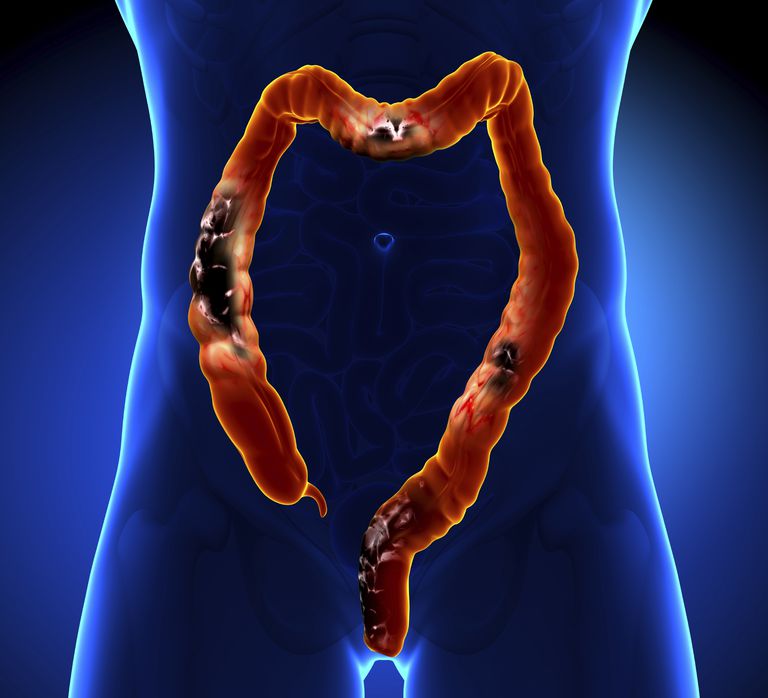 debelog crijeva, raka pluća, mogu uključivati, raka debelog, raka debelog crijeva