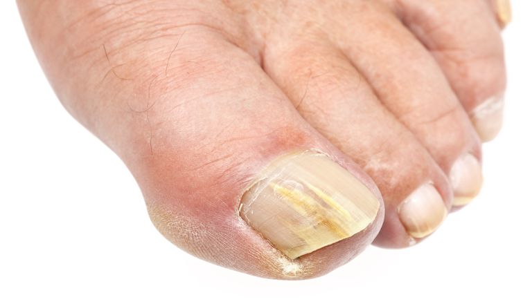toenail gljiva, debridiranje noktiju, gljivica noktiju, gljivične infekcije, noktiju gljiva, Postoji mnogo