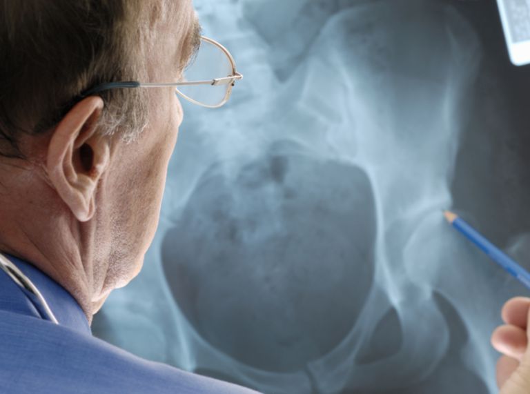 osteoporoza kuka, Prijelazna osteoporoza, dobi povezane, dobi povezane osteoporoze