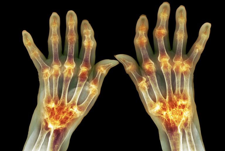 reumatoidnog artritisa, reumatoidnih artritisa, teških reumatoidnih, teških reumatoidnih artritisa, može utjecati, koji živjeli
