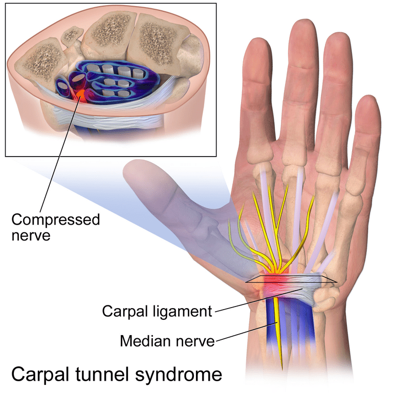 karpalnog tunela, sindroma karpalnog, sindroma karpalnog tunela, medijalnog živca, može biti, sindrom karpalnog