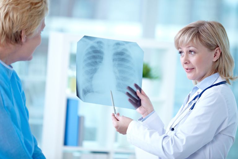 raka pluća, metastaza kostiju, metastazama kostiju, kostiju mogu