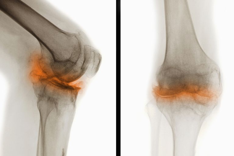 Ispravljači koljena, koljena mogu, koljena osteoartritisa, koljena pražnjenje