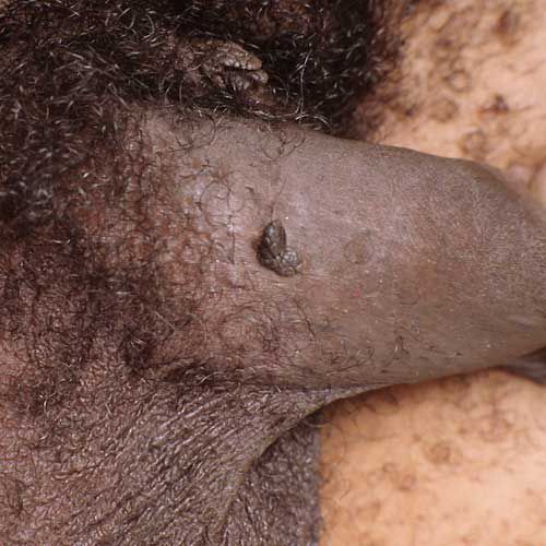 bradavica koje, mogu izgledati, području genitalija, biljne bradavice, bradavica mogu, bradavica prst