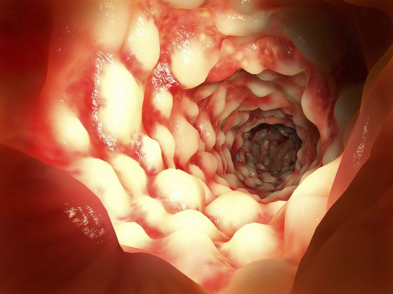 Stool Uzrok, debelog crijeva, travnja 2015, York McGraw-Hill, krvave stolice