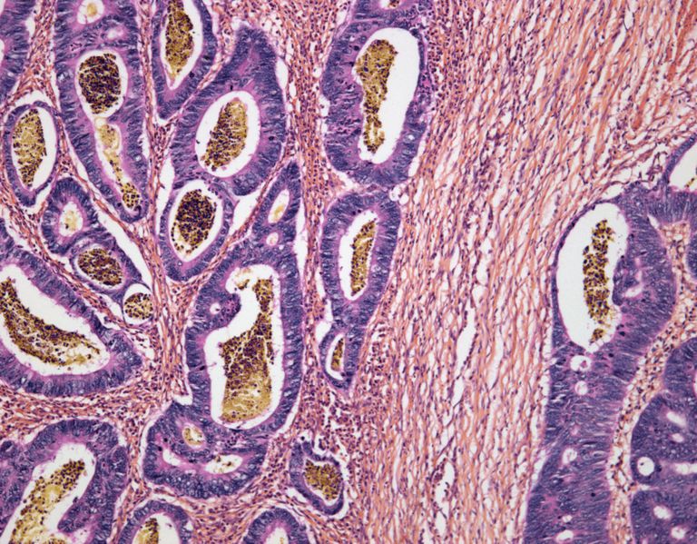 Stool Uzrok, debelog crijeva, travnja 2015, York McGraw-Hill, krvave stolice