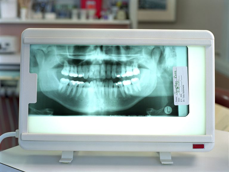 ortodontski zubni, rendgenska slika, ortodontski zubni rekordi, Panoramska rendgenska, vidite novog, zubni rekordi