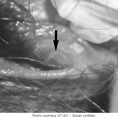 herpes simplex, bilo gdje, može biti, slika prikazuje, lezije penisu