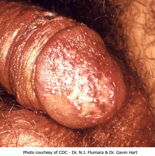 herpes simplex, bilo gdje, može biti, slika prikazuje, lezije penisu