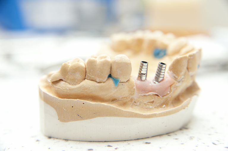 Dentalni implantati, može obaviti, oralne kirurgije, oralnog karcinoma