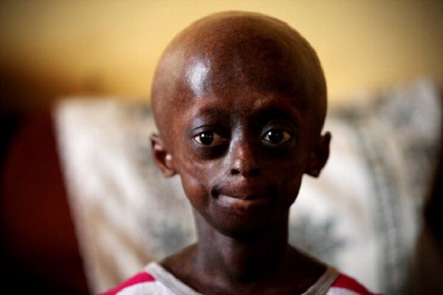 Wernerov sindrom, bolesti srca, brzo starenje, djece progerijom, genu kromosomu, nego zapravo