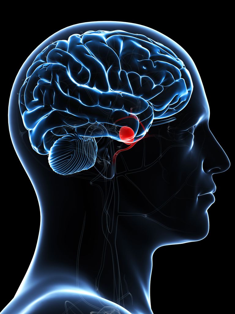 aneurizmu mozga, aneurizme mozga, aneurizme mozgu