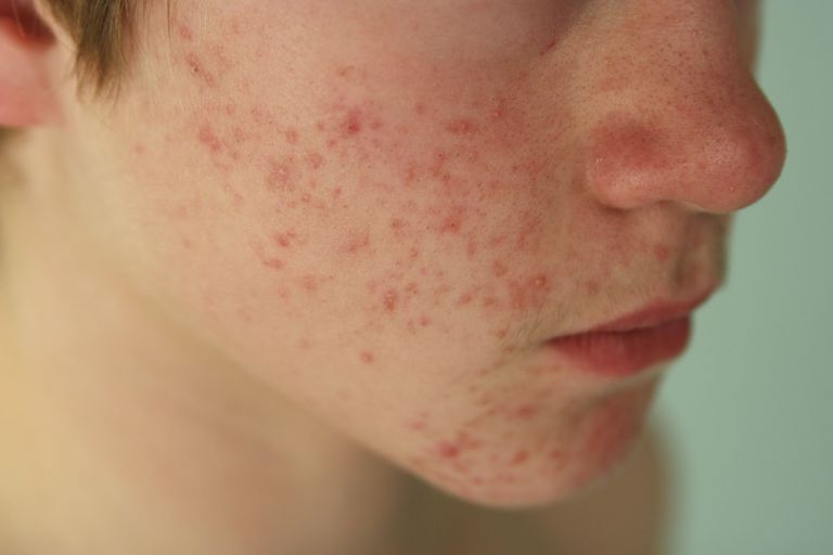 akne rosacea, acne rosacea, akne vulgaris, mogu pojaviti, rosacea odrasle