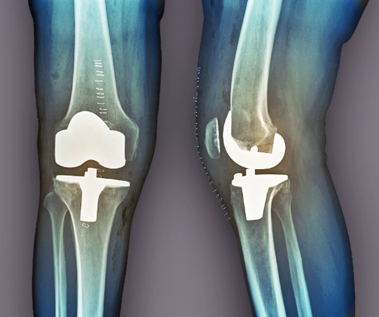 zamjene koljena, zamjenu koljena, nakon operacije, dobit ćete, kirurgija koljena, koljena treba